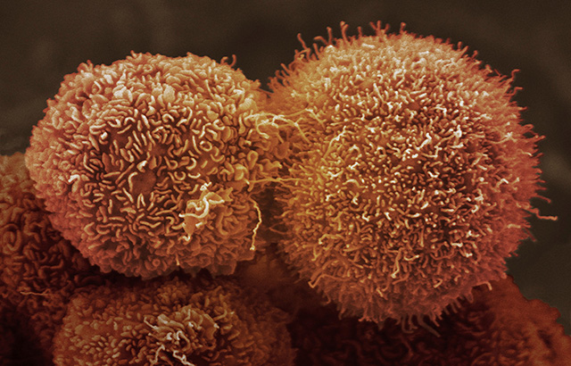 Queen Mary researchers work to enhance treatment and procedure outcomes for cancer patients