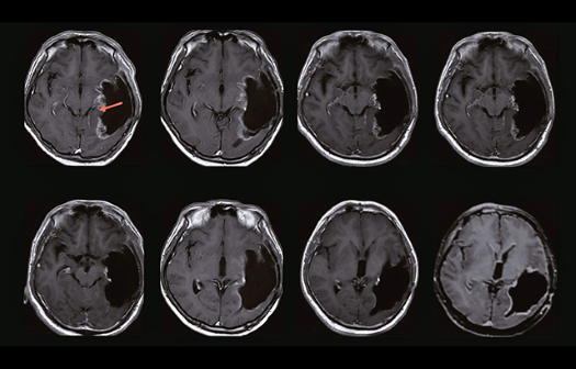 Understanding glioblastoma development 